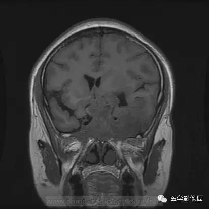 【病例】侵袭性垂体瘤1例MR影像表现
