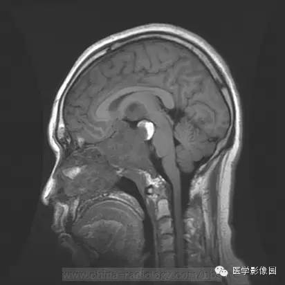 【病例】侵袭性垂体瘤1例MR影像表现