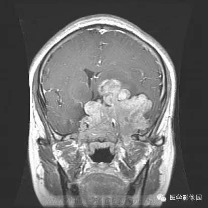 【病例】侵袭性垂体瘤1例MR影像表现