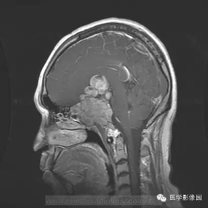 【病例】侵袭性垂体瘤1例MR影像表现