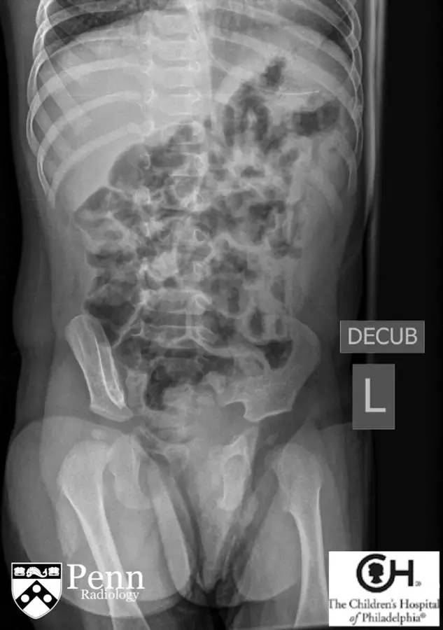 【病例】梅克尔憩室 1例影像表现 【病例】梅克尔憩室 1例影像表现
