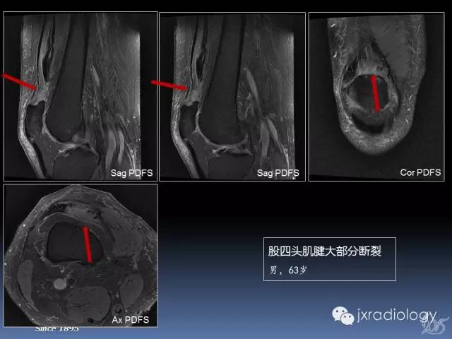 【PPT】膝关节肌腱病变的磁共振诊断