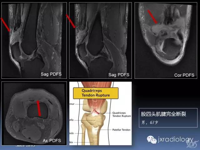 【PPT】膝关节肌腱病变的磁共振诊断
