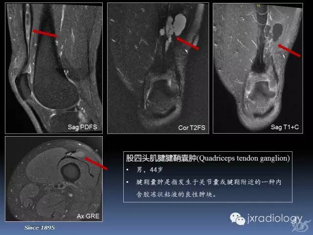 【PPT】膝关节肌腱病变的磁共振诊断