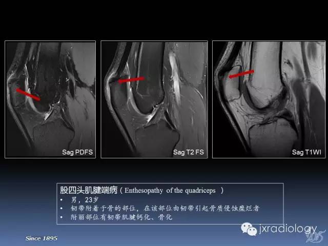 【PPT】膝关节肌腱病变的磁共振诊断