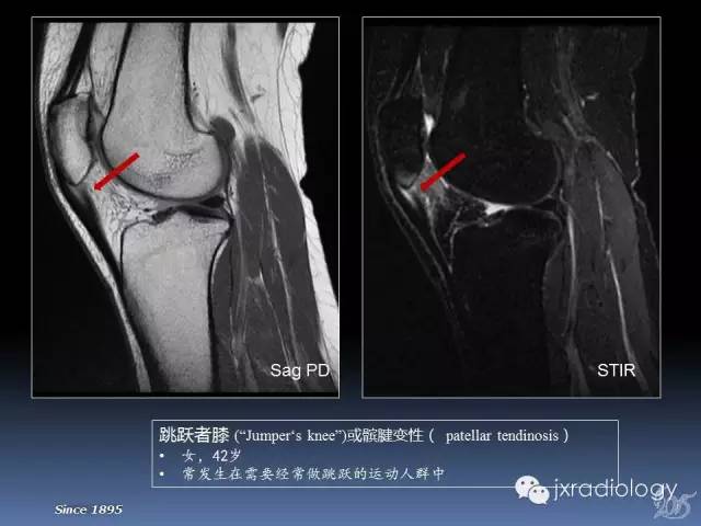【PPT】膝关节肌腱病变的磁共振诊断