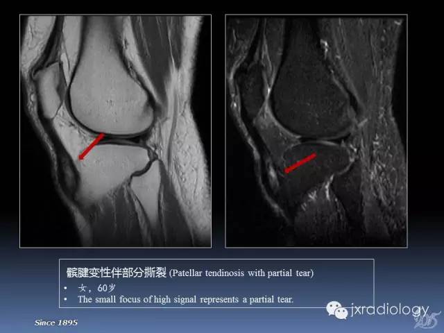 【PPT】膝关节肌腱病变的磁共振诊断
