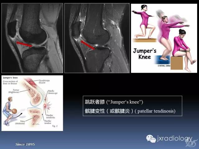 【PPT】膝关节肌腱病变的磁共振诊断