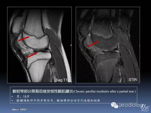 【PPT】膝关节肌腱病变的磁共振诊断