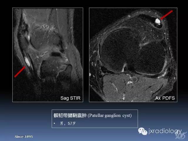 【PPT】膝关节肌腱病变的磁共振诊断