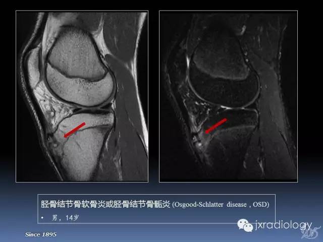 【PPT】膝关节肌腱病变的磁共振诊断