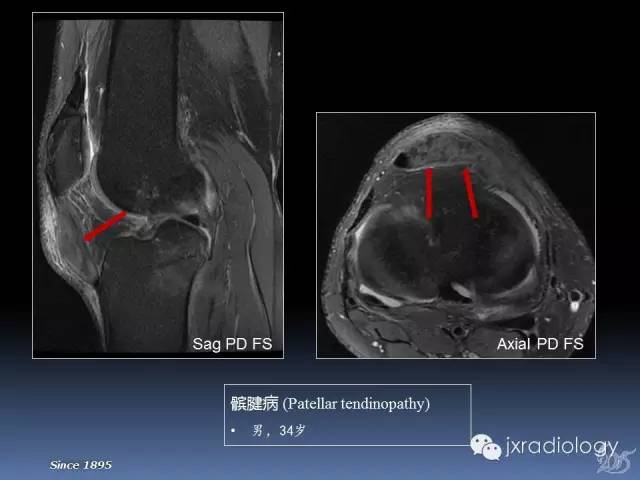 【PPT】膝关节肌腱病变的磁共振诊断
