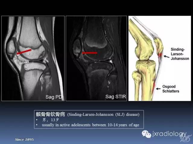 【PPT】膝关节肌腱病变的磁共振诊断