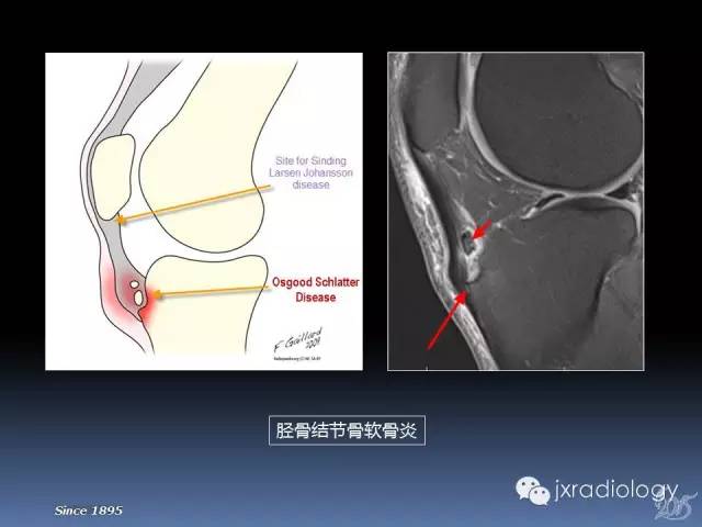 【PPT】膝关节肌腱病变的磁共振诊断