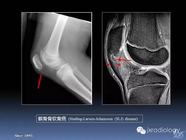 【PPT】膝关节肌腱病变的磁共振诊断