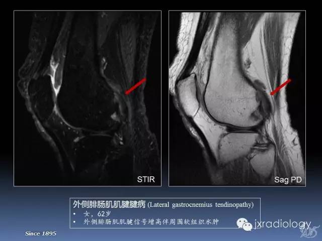 【PPT】膝关节肌腱病变的磁共振诊断