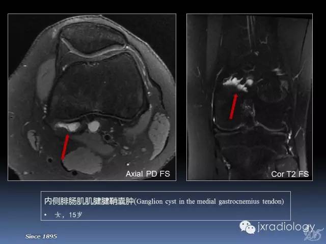 【PPT】膝关节肌腱病变的磁共振诊断