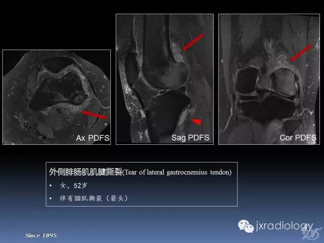 【PPT】膝关节肌腱病变的磁共振诊断
