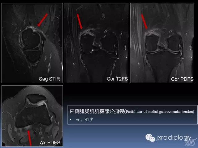 【PPT】膝关节肌腱病变的磁共振诊断