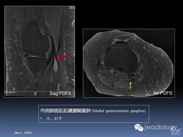 【PPT】膝关节肌腱病变的磁共振诊断