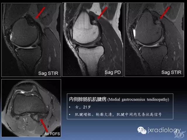 【PPT】膝关节肌腱病变的磁共振诊断