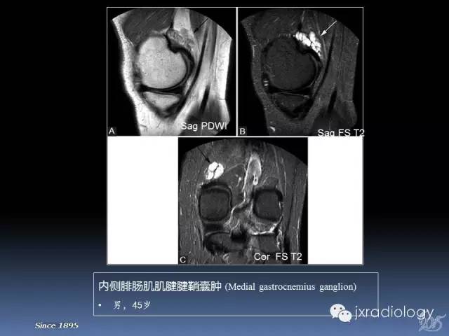 【PPT】膝关节肌腱病变的磁共振诊断