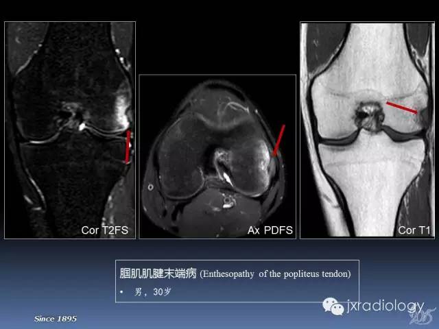 【PPT】膝关节肌腱病变的磁共振诊断