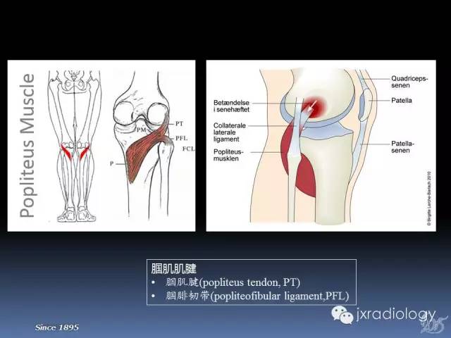【PPT】膝关节肌腱病变的磁共振诊断