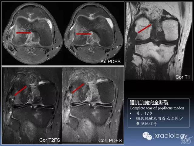 【PPT】膝关节肌腱病变的磁共振诊断