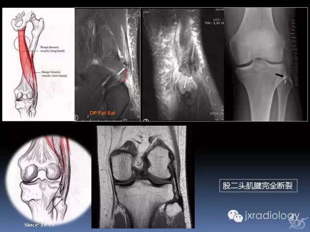【PPT】膝关节肌腱病变的磁共振诊断