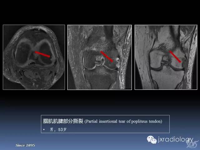 【PPT】膝关节肌腱病变的磁共振诊断