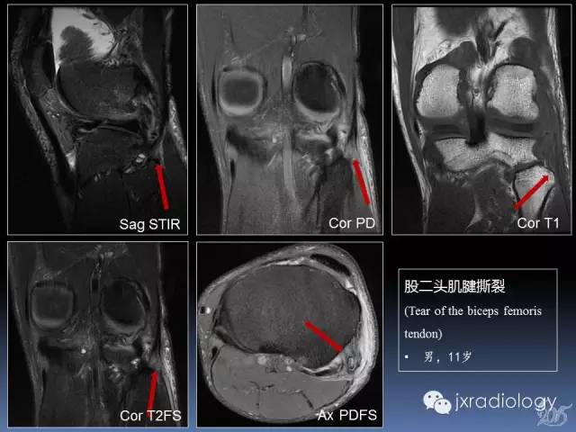 【PPT】膝关节肌腱病变的磁共振诊断