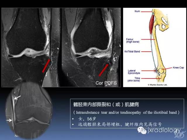 【PPT】膝关节肌腱病变的磁共振诊断