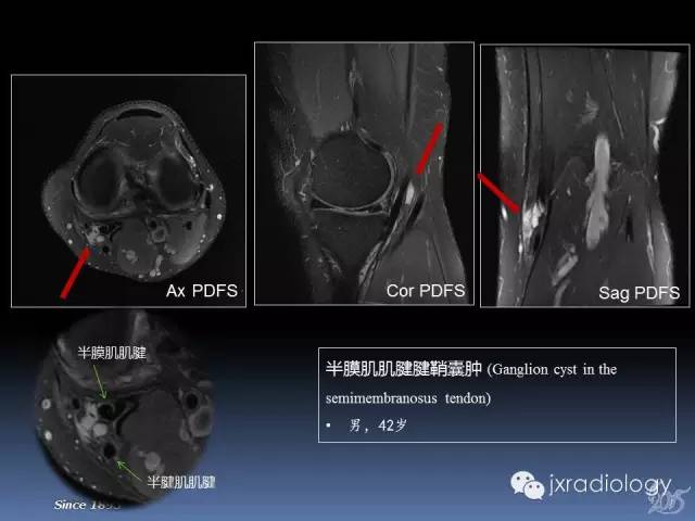 【PPT】膝关节肌腱病变的磁共振诊断