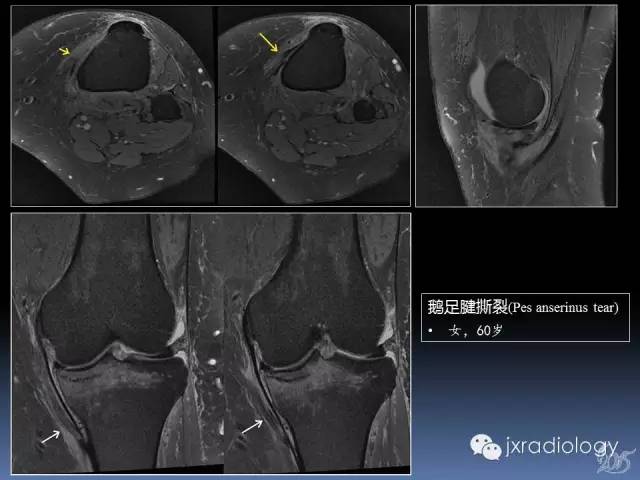 【PPT】膝关节肌腱病变的磁共振诊断