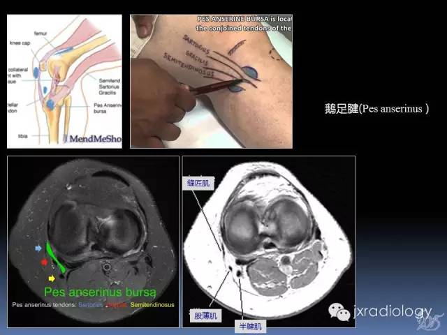 【PPT】膝关节肌腱病变的磁共振诊断
