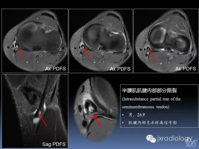 【PPT】膝关节肌腱病变的磁共振诊断