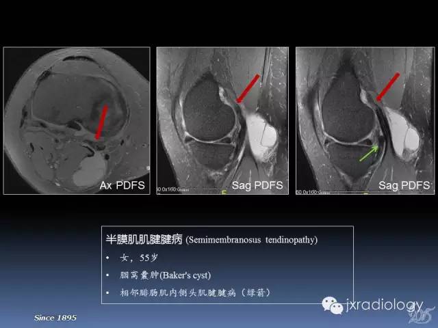 【PPT】膝关节肌腱病变的磁共振诊断