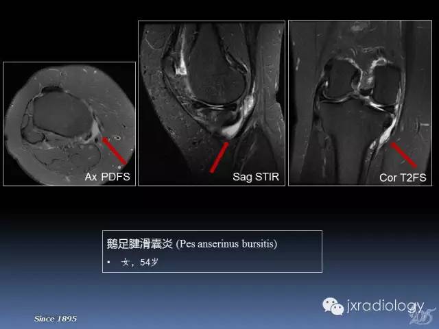【PPT】膝关节肌腱病变的磁共振诊断