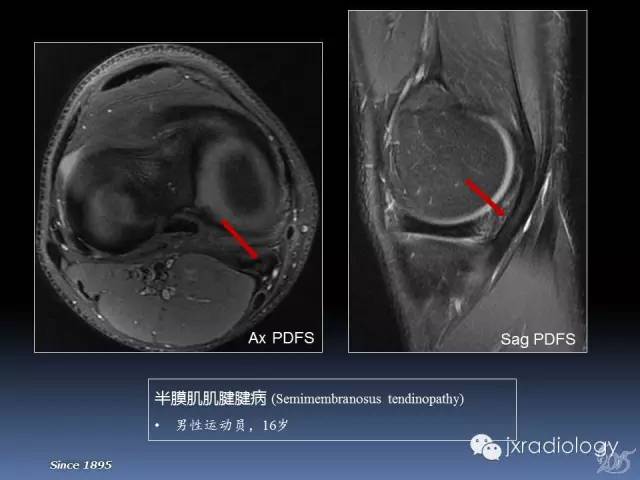 【PPT】膝关节肌腱病变的磁共振诊断