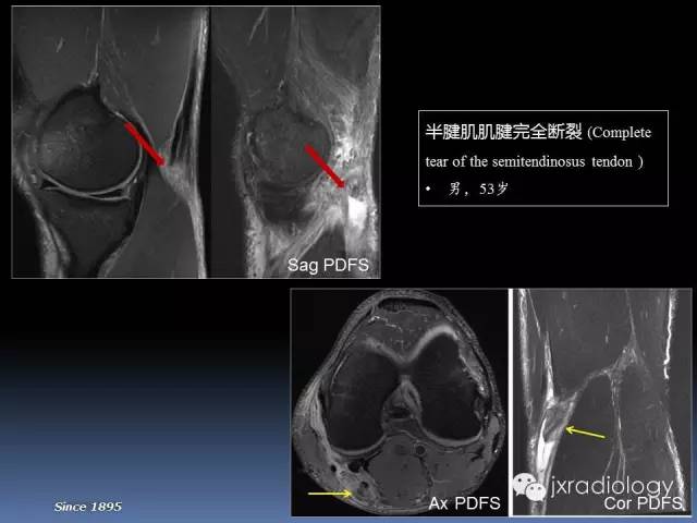 【PPT】膝关节肌腱病变的磁共振诊断