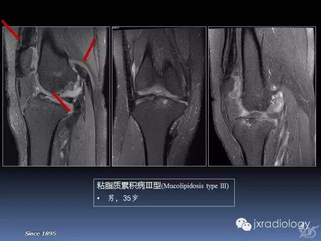 【PPT】膝关节肌腱病变的磁共振诊断