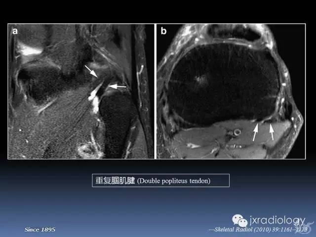【PPT】膝关节肌腱病变的磁共振诊断
