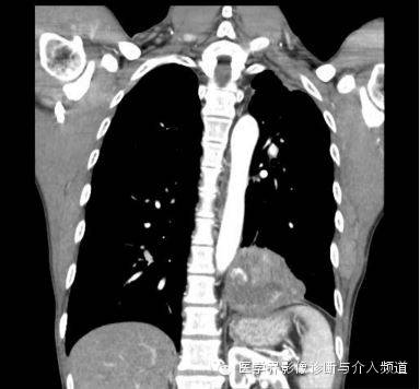 【病例】肺部纱布瘤1例CT影像表现 【病例】肺部纱布瘤1例CT影像表现