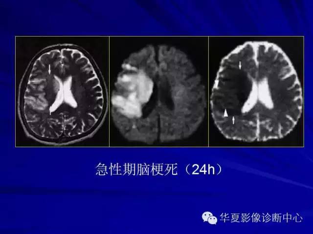 脑梗死不同时期的DWI表现 脑梗死不同时期的DWI表现