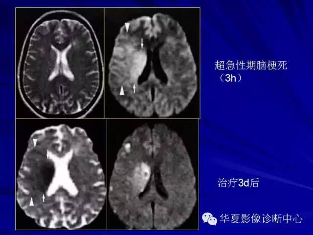 脑梗死不同时期的DWI表现 脑梗死不同时期的DWI表现