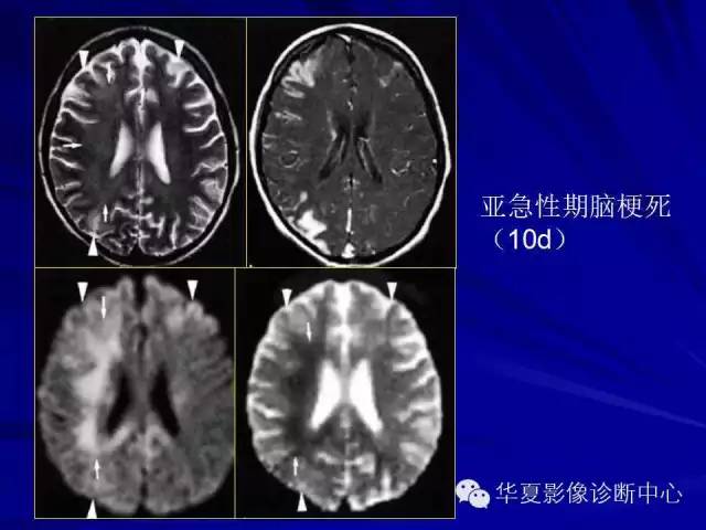 脑梗死不同时期的DWI表现 脑梗死不同时期的DWI表现