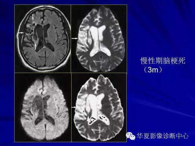 脑梗死不同时期的DWI表现 脑梗死不同时期的DWI表现