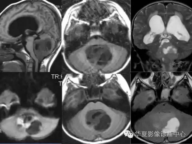 【病例】髓母细胞瘤1例MR影像表现