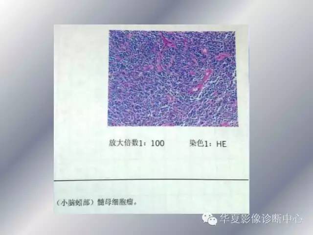 【病例】髓母细胞瘤1例MR影像表现